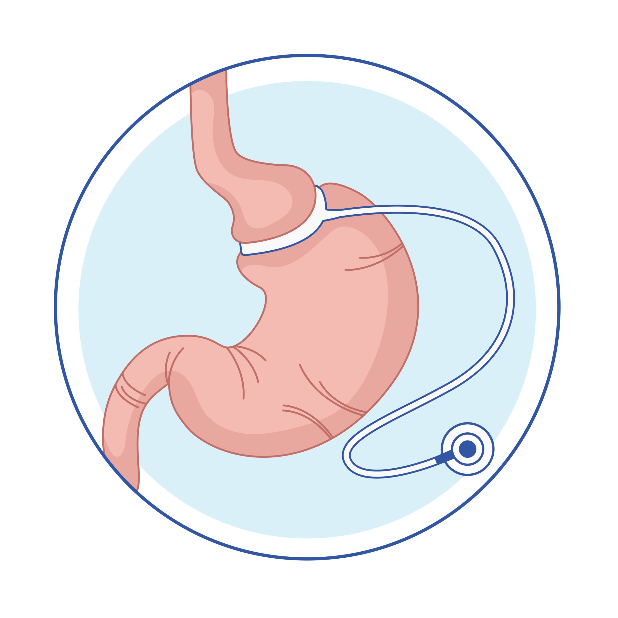 What Is Gastric Band Surgery and How Is It Performed? - Dr. Ceyhun Aydoğan